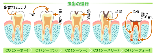 虫歯の進行