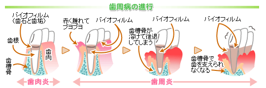 歯周病の進行