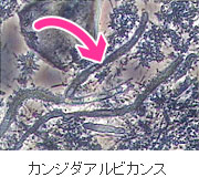 歯周病の原因：真菌（カビ） − カンジダアルビカンス