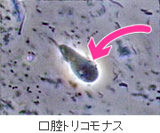 歯周病の原因：原虫 − 口腔トリコモナス