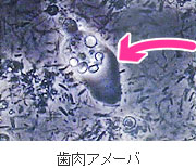 歯周病の原因：原虫 − 歯肉アメーバ