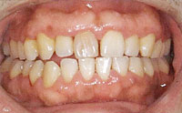 歯周内科治療：治療開始３週間後