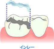 オールジルコニアインレー