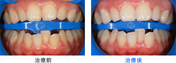オフィスホワイトニングの治療例