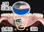 総入れ歯