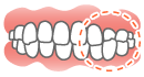 交叉咬合(こうさこうごう)