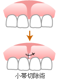 小帯切除術