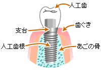 インプラント